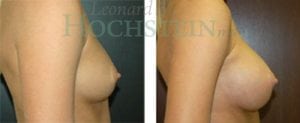 Breast Augmentation Patient