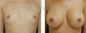 Breast Augmentation Patient