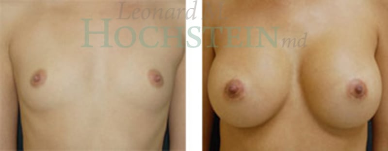 Breast Augmentation Patient