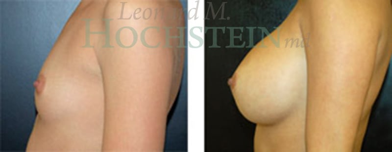 Breast Augmentation Patient