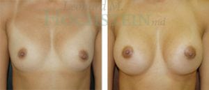 Breast Augmentation Patient