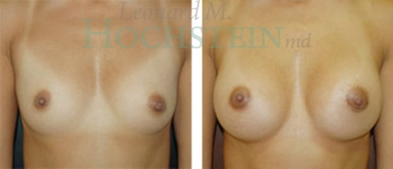Breast Augmentation Patient