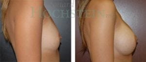 Breast Augmentation Patient