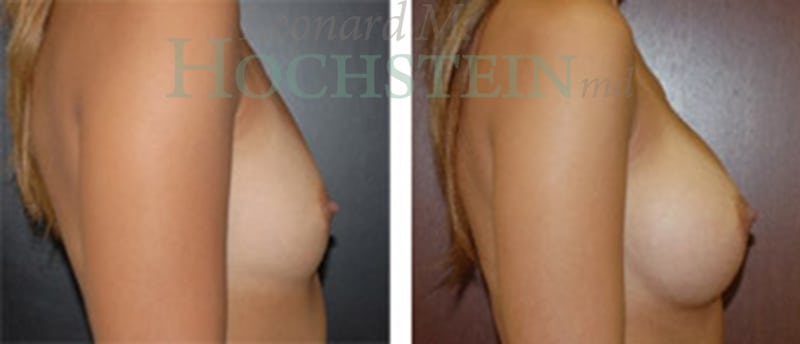 Breast Augmentation Patient
