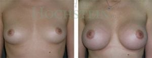 Breast Augmentation Patient 32