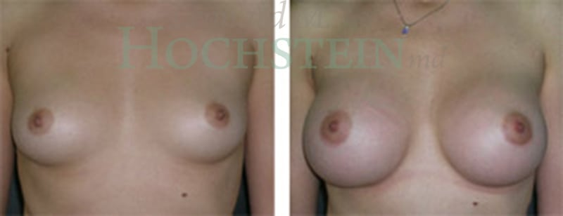 Breast Augmentation Patient