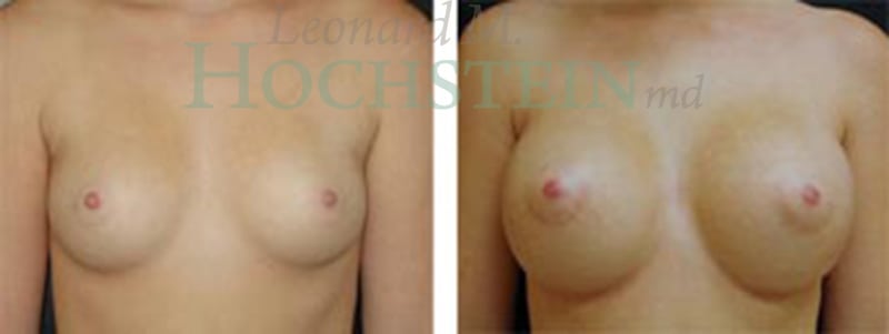 Breast Augmentation Patient