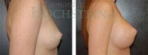 Breast Augmentation Patient