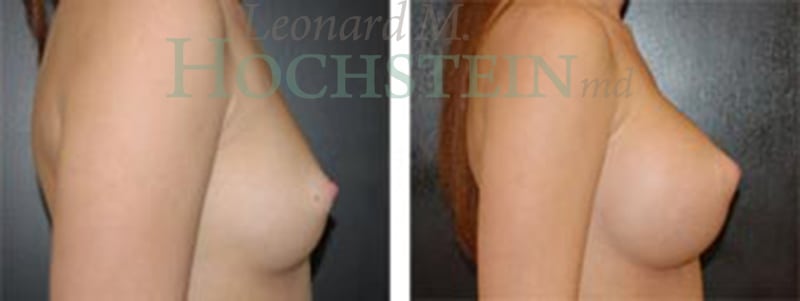 Breast Augmentation Patient