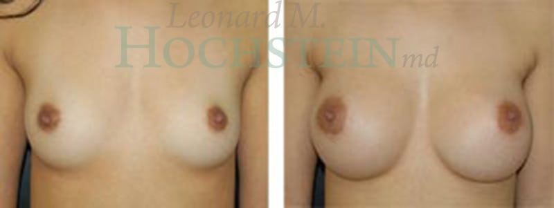 Breast Augmentation Patient