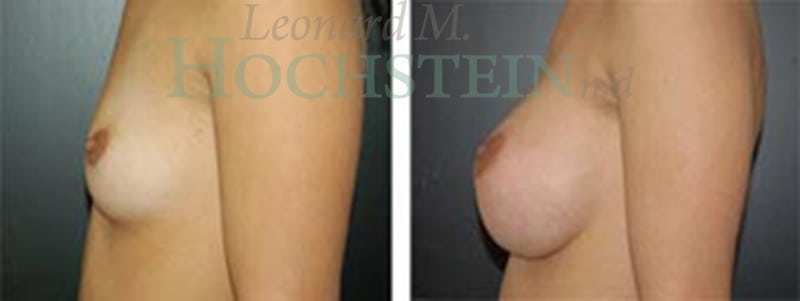 Breast Augmentation Patient