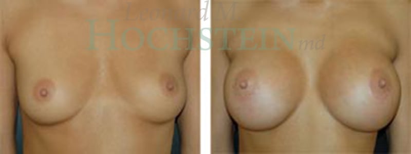 Breast Augmentation Patient