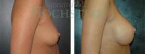 Breast Augmentation Patient
