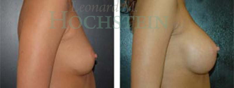 Breast Augmentation Patient