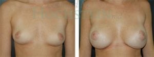 Breast Augmentation Patient