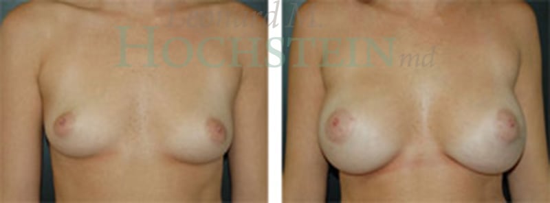 Breast Augmentation Patient