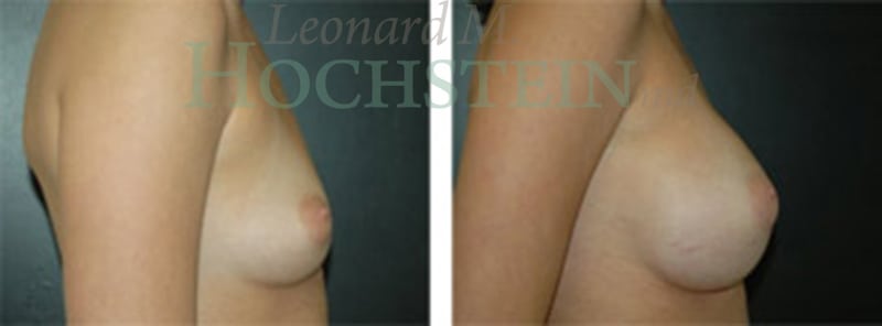 Breast Augmentation Patient