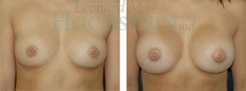 Breast Augmentation Patient