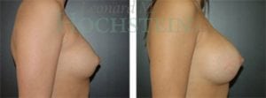 Breast Augmentation Patient