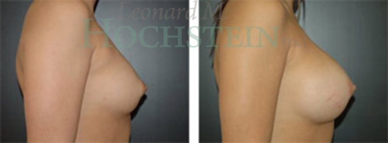 Breast Augmentation Patient
