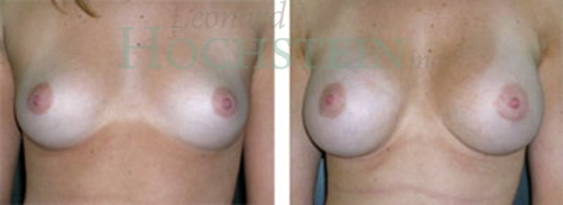 Breast Augmentation Patient