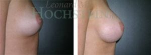 Breast Augmentation Patient