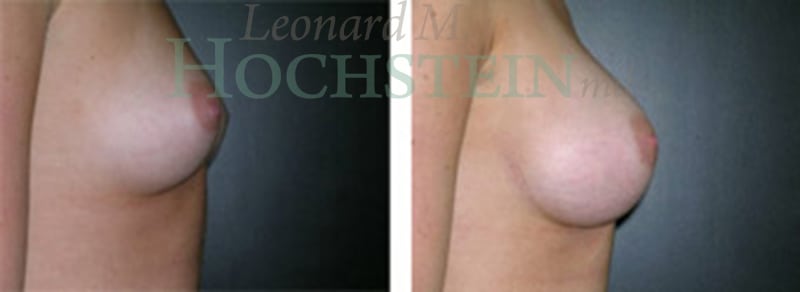 Breast Augmentation Patient