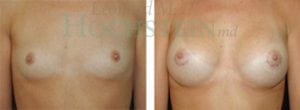 Breast Augmentation Patient