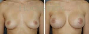 Breast Augmentation Patient