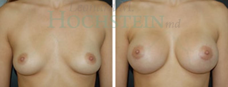 Breast Augmentation Patient