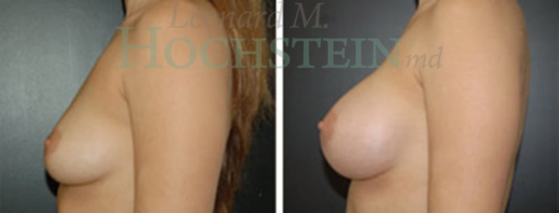 Breast Augmentation Patient