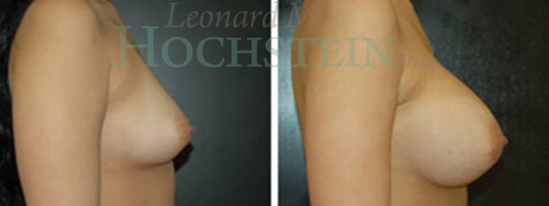 Breast Augmentation Patient