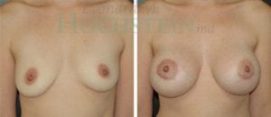 Breast Augmentation Patient