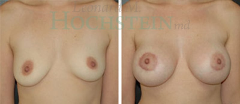 Breast Augmentation Patient