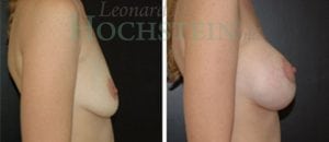 Breast Augmentation Patient