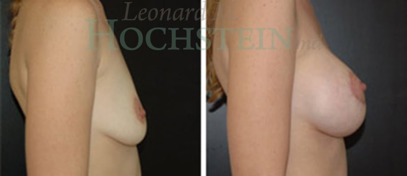 Breast Augmentation Patient