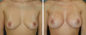 Breast Augmentation Patient