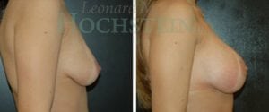 Breast Augmentation Patient