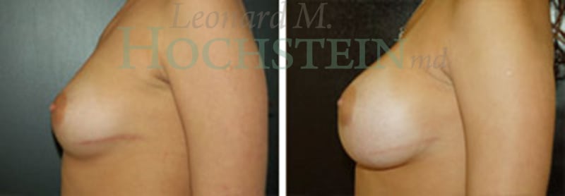 Breast Augmentation Patient