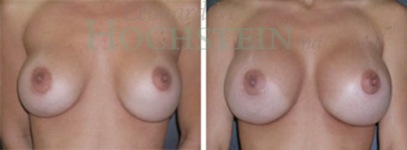 Breast Augmentation Patient