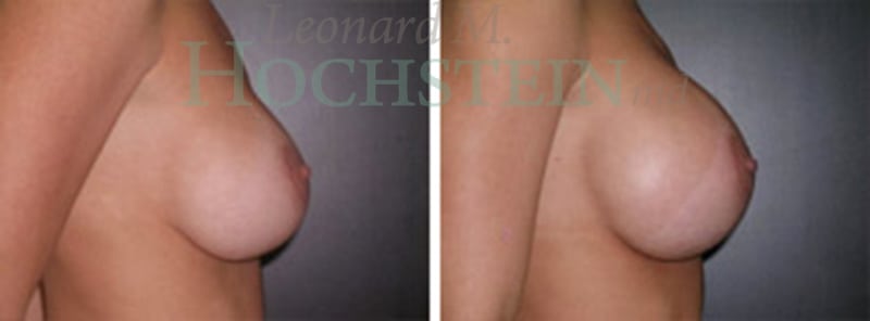 Breast Augmentation Patient