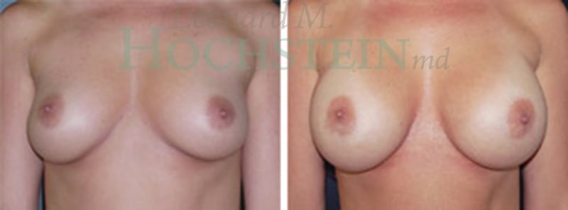 Breast Augmentation Patient