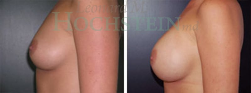 Breast Augmentation Patient