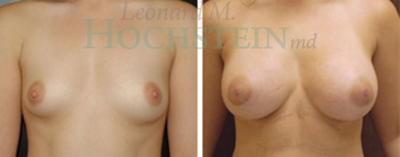 Breast Augmentation Patient