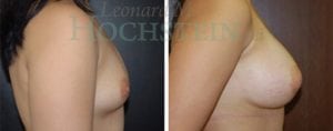 Breast Augmentation Patient