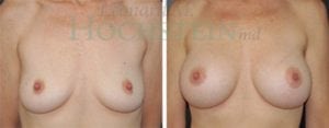 Breast Augmentation Patient