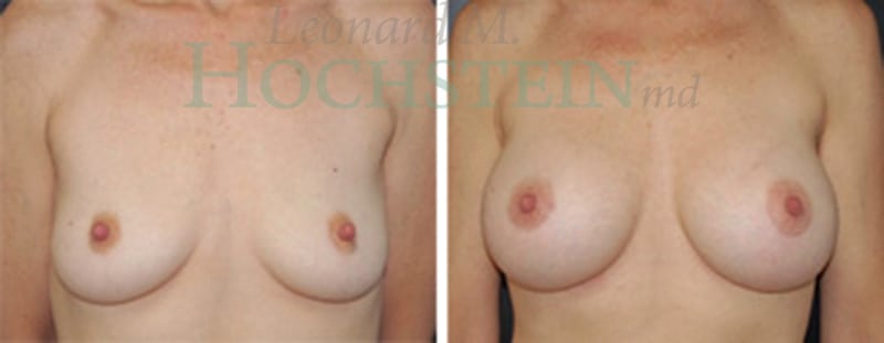 Breast Augmentation Patient