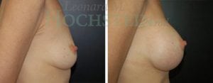 Breast Augmentation Patient