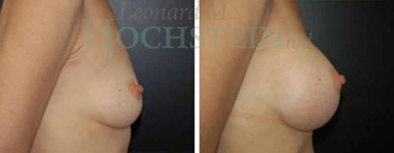 Breast Augmentation Patient