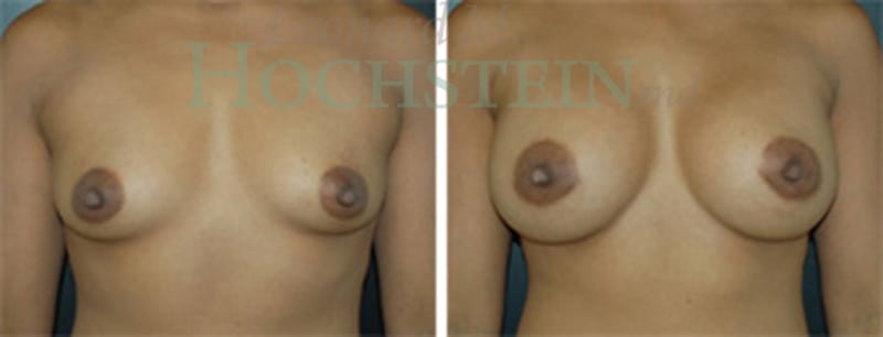 Breast Augmentation Patient